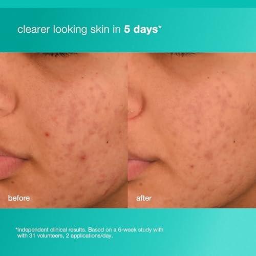 Dermalogica Acne Biotic Feuchtigkeitscreme – Leichte Tageslotion gegen Hautalterung und Unreinheiten, 50 ml