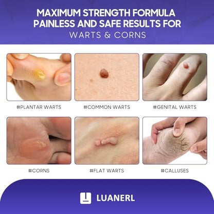 luanerl Warzen- & Hühneraugenentferner, 20 % Salicylsäure mit natürlicher Formel, maximale Stärke, schnell wirkend gegen Warzen, Dornwarzen, Genitalwarzen, gewöhnliche Warzen, Hornhaut – 0,4 fl oz (12 ml)