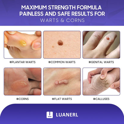 luanerl Warzen- & Hühneraugenentferner, 20 % Salicylsäure mit natürlicher Formel, maximale Stärke, schnell wirkend gegen Warzen, Dornwarzen, Genitalwarzen, gewöhnliche Warzen, Hornhaut – 0,4 fl oz (12 ml)