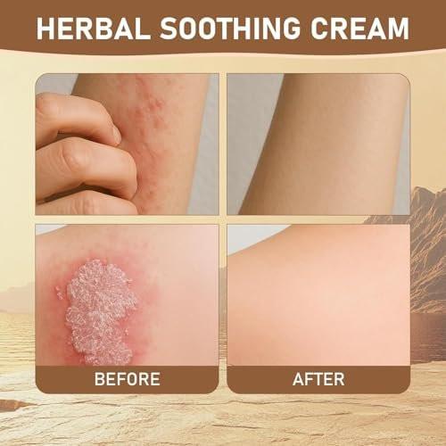 Rulinal Kräuter-Beruhigungscreme - Antibakterielle Naturcreme gegen Psoriasis, Ekzeme & Hautprobleme - 85g