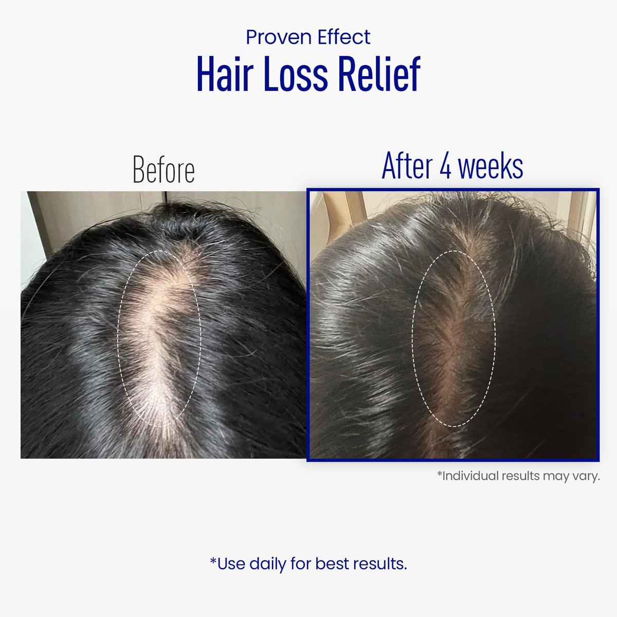 ViveLab Scalp Microneedle Serum – K-Beauty Haarwachstum & Kopfhautbehandlung mit Spioxyl™ 400 | Füllt Haaransatz, stärkt Wurzeln, reduziert Haarausfall – 220.000 Mikronadeln Formel