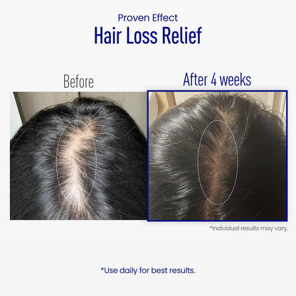 ViveLab Scalp Microneedle Serum – K-Beauty Haarwachstum & Kopfhautbehandlung mit Spioxyl™ 400 | Füllt Haaransatz, stärkt Wurzeln, reduziert Haarausfall – 220.000 Mikronadeln Formel