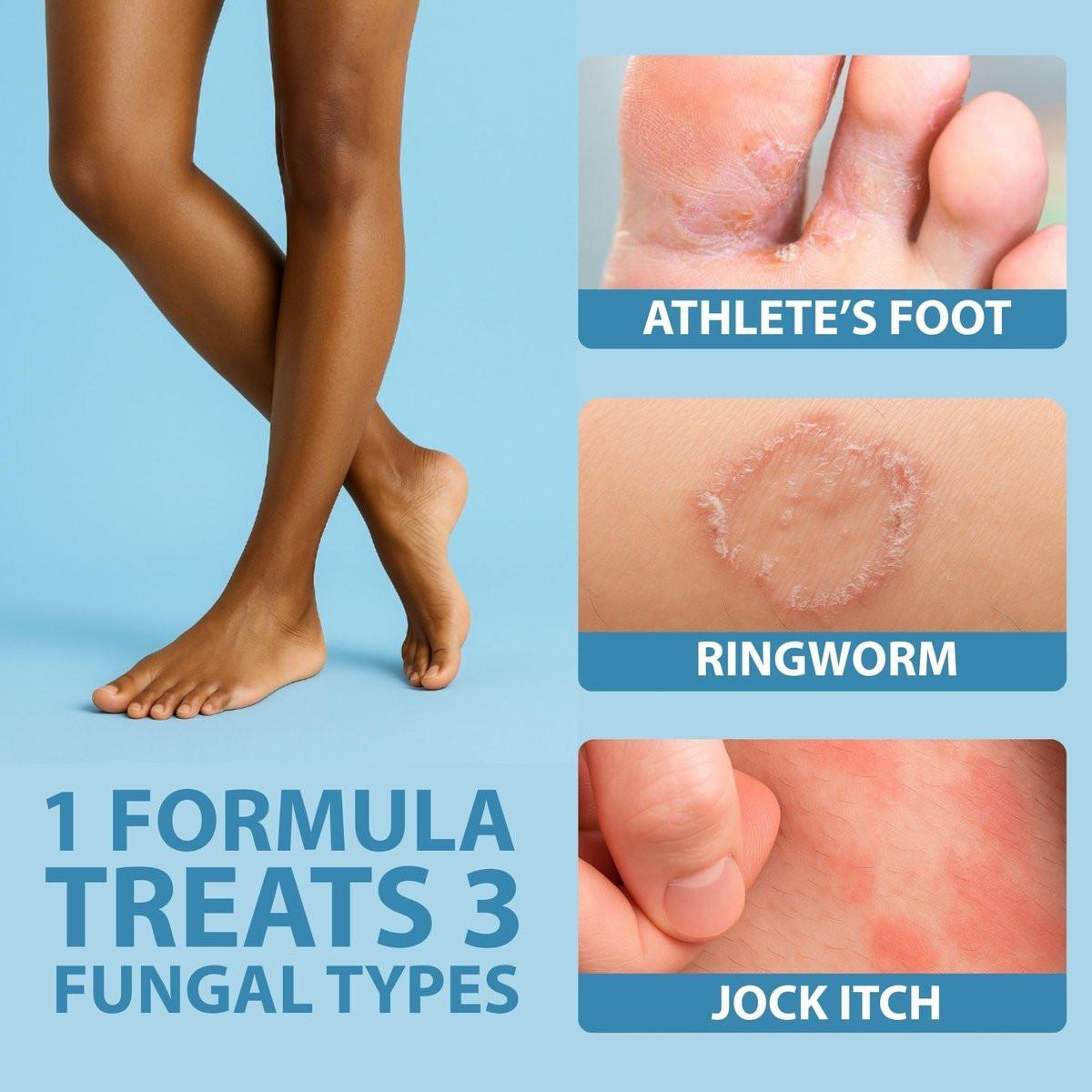 Curist Terbinafin Creme 1% – Antimykotische Fußpilzbehandlung, 30 g (1 Unze) – Gegen Fußpilz, Ringelflechte & Jock Itch