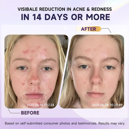 10% Azelainsäure Akne Behandlung für das Gesicht – Hormonelle/Zystische Akne Spot Treatment Creme | Rötungsreduzierende Akne Feuchtigkeitscreme für Rosacea & empfindliche, zu Akne neigende Haut | Jugendliche & Erwachsene, 1,7 oz