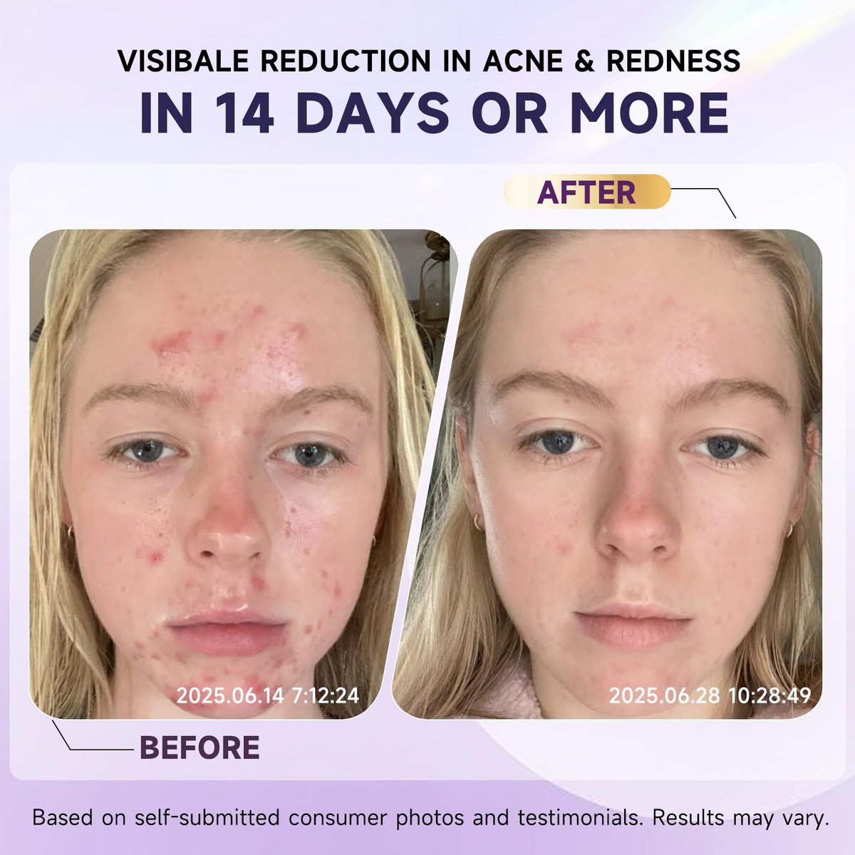 10% Azelainsäure Akne Behandlung für das Gesicht – Hormonelle/Zystische Akne Spot Treatment Creme | Rötungsreduzierende Akne Feuchtigkeitscreme für Rosacea & empfindliche, zu Akne neigende Haut | Jugendliche & Erwachsene, 1,7 oz