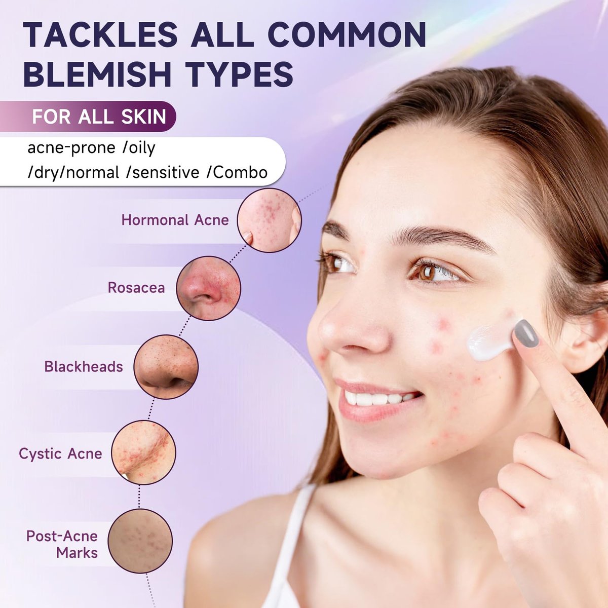 10% Azelainsäure Akne Behandlung für das Gesicht – Hormonelle/Zystische Akne Spot Treatment Creme | Rötungsreduzierende Akne Feuchtigkeitscreme für Rosacea & empfindliche, zu Akne neigende Haut | Jugendliche & Erwachsene, 1,7 oz