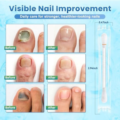 Fußnagelpilz-Behandlungstücher – 100 Stück, extra starke Zehennagel- & Fußpilzbehandlung mit 25% Undecylensäure, beschädigte, verfärbte & dicke Nägel, stellt gesundes Nagelwachstum wieder her