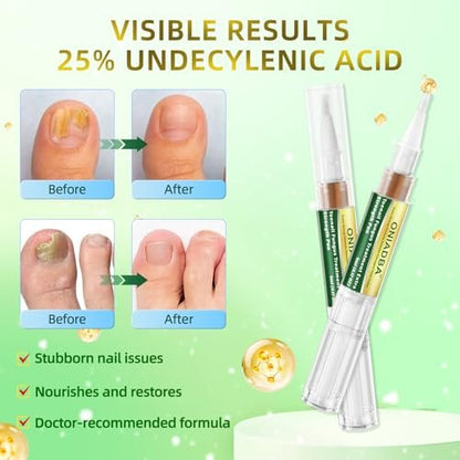 Nagelpilz-Behandlungsstift Extra Stark – Repariert gelbe, verfärbte, dicke & eingewachsene Nägel – Pilzlösung für Zehen- & Fingernägel – (6 x 5 ml/0,17 Fl. Oz Stifte)