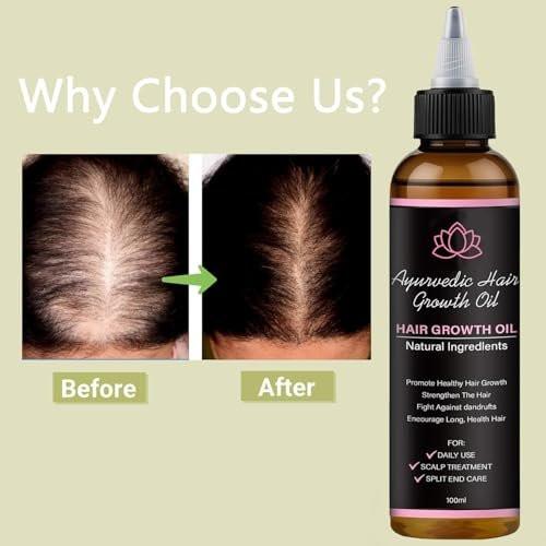 Lifewitqueenp Haarwuchsöl – Ayurvedisches Haaröl für alle Haartypen, leichtes Pflegeöl (1 Flasche)