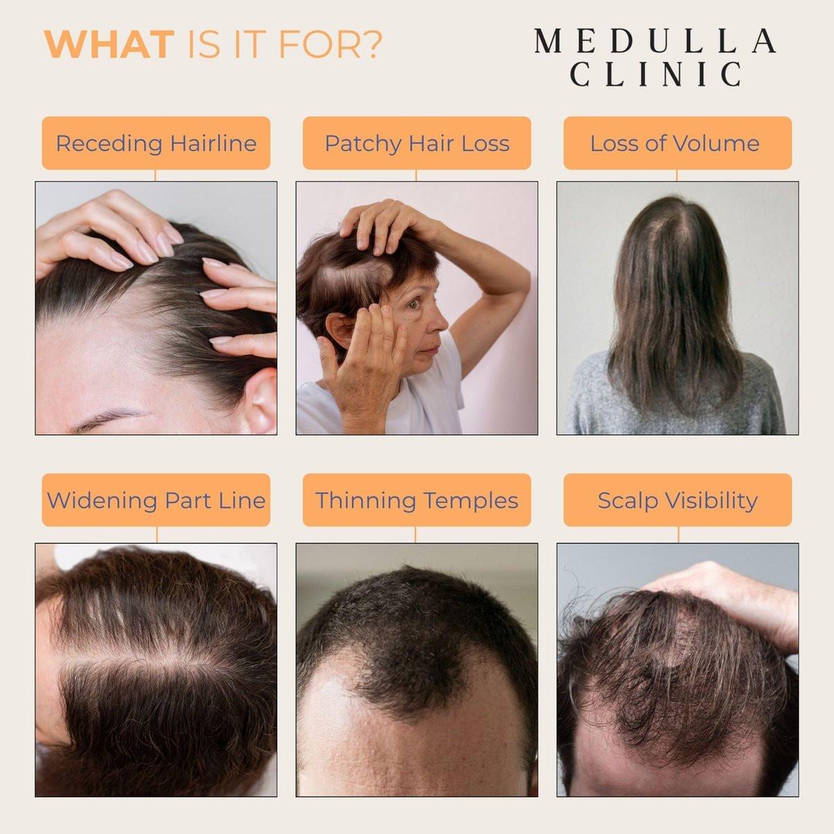 Medulla Clinic Haarwuchs Serum Roll-On – 5% Rosmarin, 3% Protein & 2% Koffein – Batana-Öl & Biotin für Kopfhaut & Haarverdickung – Gezielte, nicht fettende Behandlung – 30 ml