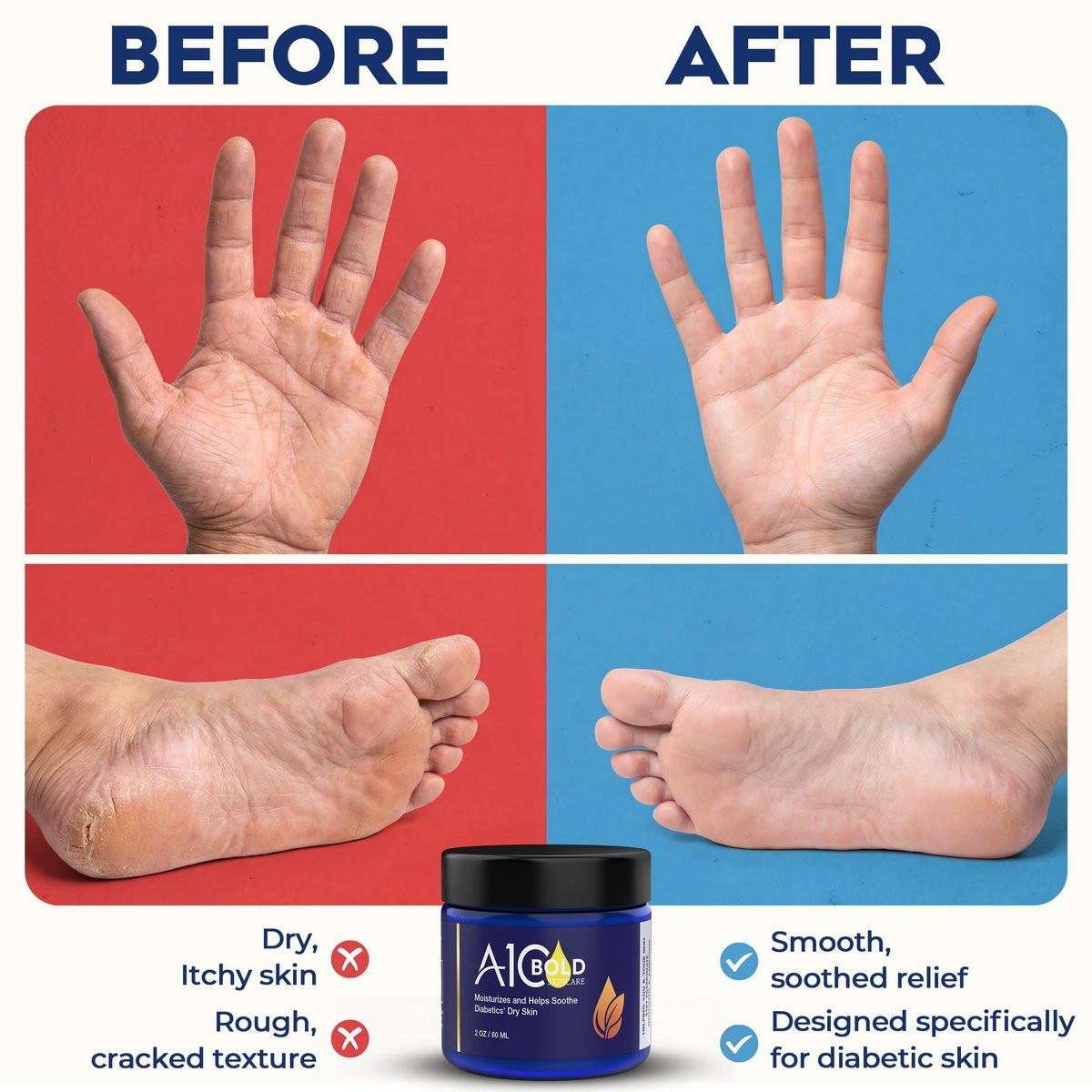 A1C BOLD SKINCARE Diabetic Care Balm – Pflegebalsam für Diabetiker mit Bienenwachs & Vitamin E, Feuchtigkeitscreme für trockene, rissige Hände & Füße, lang anhaltende Hydratation für empfindliche Haut, 56 g