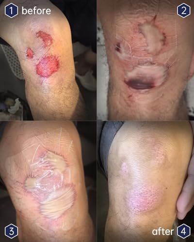 yehooheal Hydrokolloid Wundauflage – 0,004 Zoll ultradünne Zweite Haut, wasserdicht, schnelle Heilung, weniger Narben, hält 7 Tage, für Outdoor-Erste Hilfe (HSA FSA geeignet)