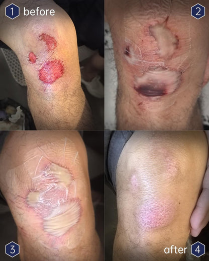 yehooheal Hydrokolloid Wundauflage – 0,004 Zoll ultradünne Zweite Haut, wasserdicht, schnelle Heilung, weniger Narben, hält 7 Tage, für Outdoor-Erste Hilfe (HSA FSA geeignet)