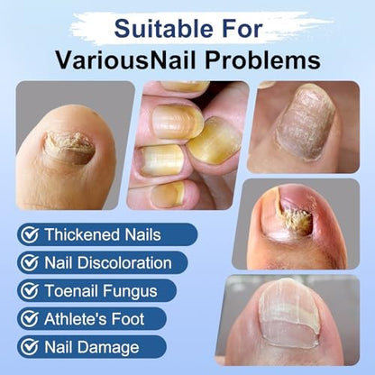 Nagelpilz Behandlung Extra Stärke, Fungi Nail Pen, 25% Undecylensäure, Behandlung von eingewachsenen Zehennägeln, Repariert gelbe, dicke, brüchige Zehen- und Fußpilzbehandlung extra stark - 3 Stück