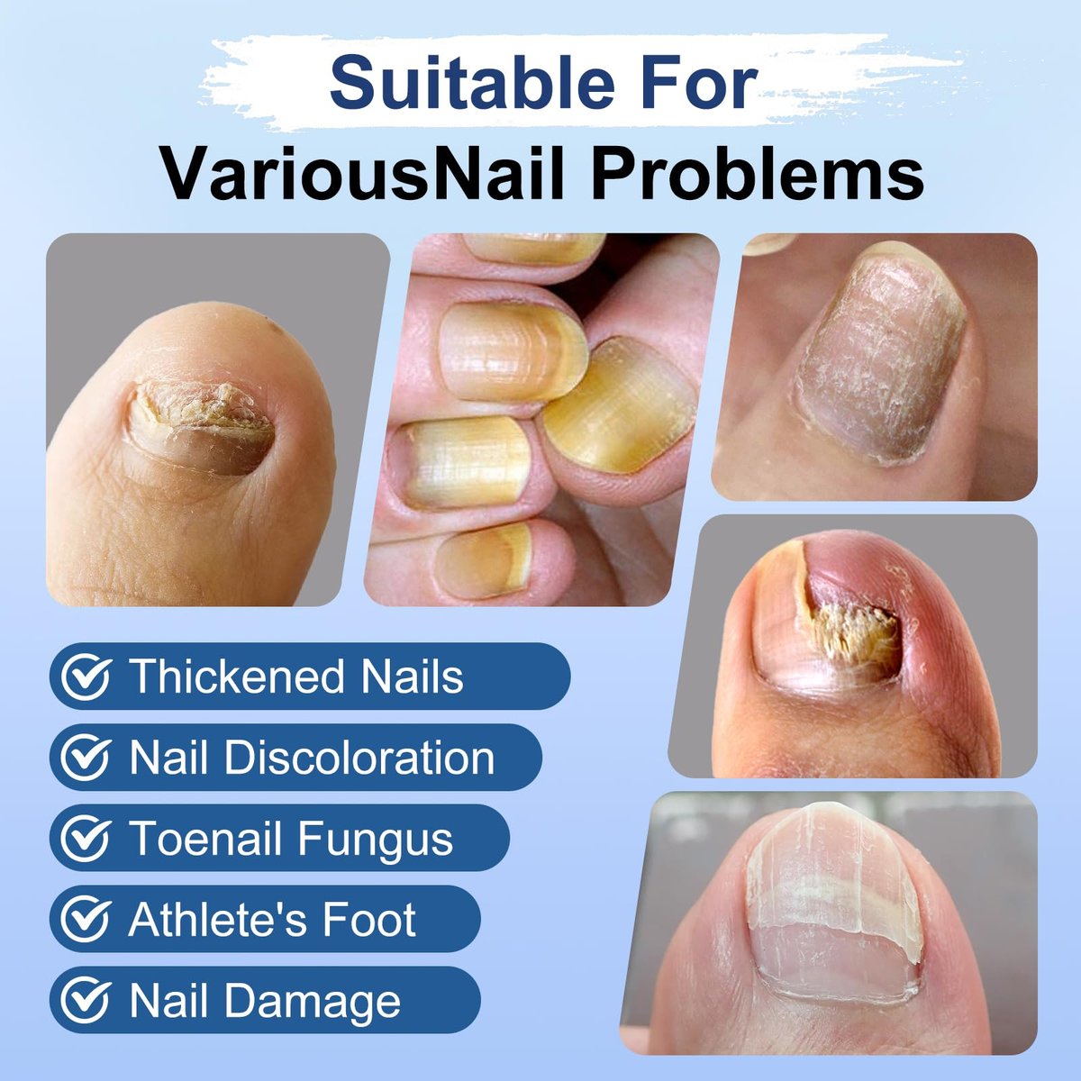 Nagelpilz Behandlung Extra Stärke, Fungi Nail Pen, 25% Undecylensäure, Behandlung von eingewachsenen Zehennägeln, Repariert gelbe, dicke, brüchige Zehen- und Fußpilzbehandlung extra stark - 3 Stück