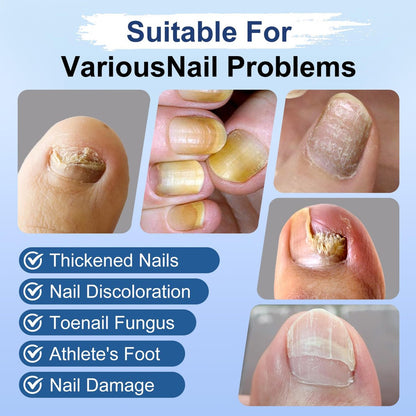 Nagelpilz Behandlung Extra Stärke, Fungi Nail Pen, 25% Undecylensäure, Behandlung von eingewachsenen Zehennägeln, Repariert gelbe, dicke, brüchige Zehen- und Fußpilzbehandlung extra stark - 3 Stück