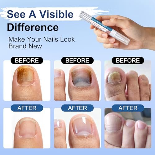 Nagelpilz Behandlung Extra Stärke, Fungi Nail Pen, 25% Undecylensäure, Behandlung von eingewachsenen Zehennägeln, Repariert gelbe, dicke, brüchige Zehen- und Fußpilzbehandlung extra stark - 3 Stück