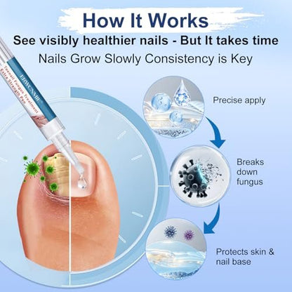 Nagelpilz Behandlung Extra Stärke, Fungi Nail Pen, 25% Undecylensäure, Behandlung von eingewachsenen Zehennägeln, Repariert gelbe, dicke, brüchige Zehen- und Fußpilzbehandlung extra stark - 3 Stück