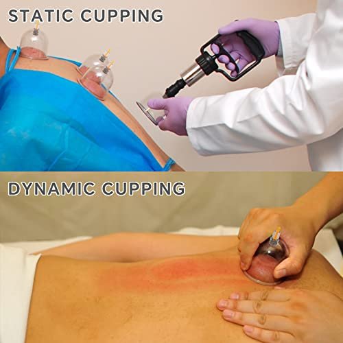 AIKOTOO Schröpfen-Set für Massagetherapie mit Pumpe – 12 Schröpfgläser zur Reduzierung von Cellulite, Muskel- und Rückenschmerzen