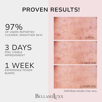BellamiLuxx Butt Acne Treatment Set: Seife & Lotion gegen Pickel am Po, Oberschenkeln, Rücken und Brust – Reduziert Körperausbrüche