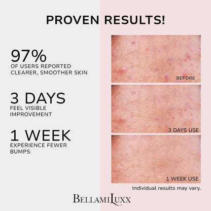 BellamiLuxx Butt Acne Treatment Set: Seife & Lotion gegen Pickel am Po, Oberschenkeln, Rücken und Brust – Reduziert Körperausbrüche
