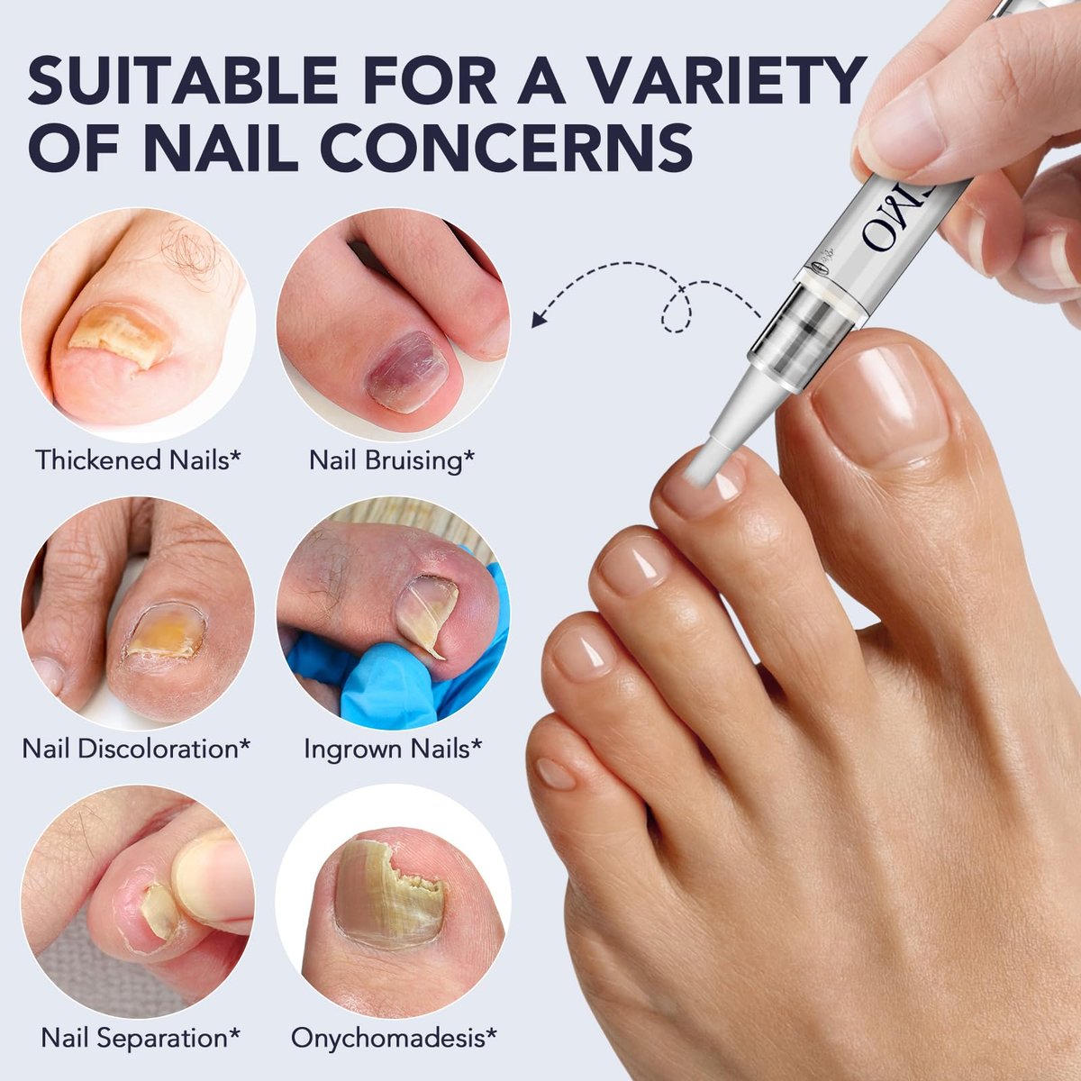 Nagelpilz Stift - Starke Nagelpilzbehandlung mit 25% Undecylensäure, Teebaum & Jojoba - Nagelpilz Reparatur Set für beschädigte, verfärbte, eingewachsene Nägel (5er Pack)