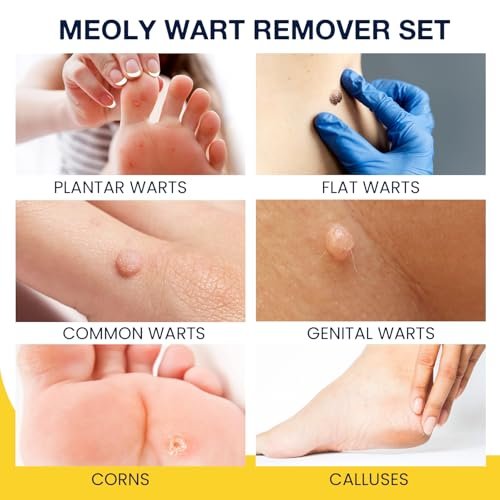 MEOLY Plantar Warzen Entferner Set: Maximale Stärke Salicylsäure Warzenpflaster mit 12 dicken Polsterpads