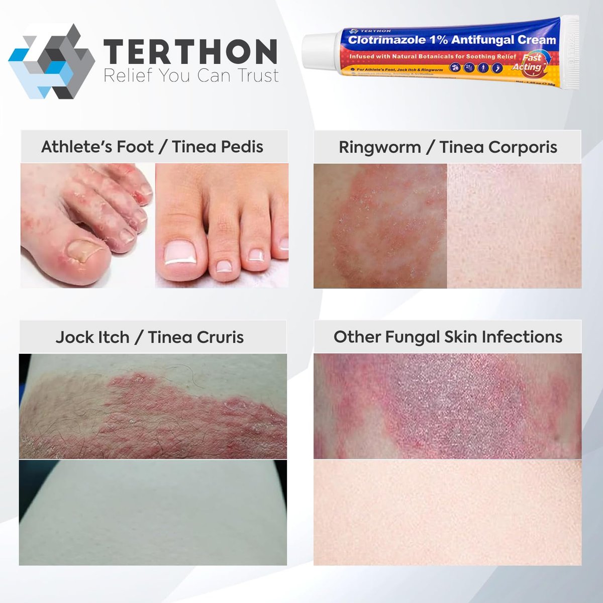 Terthon Clotrimazol Antimykotische Creme Behandlung – Maximale Stärke gegen Fußpilz, Juckreiz, Ringelflechte & Hefepilzinfektion – Schnell wirkende Juckreizlinderung für Füße, Leisten & Haut – 30g