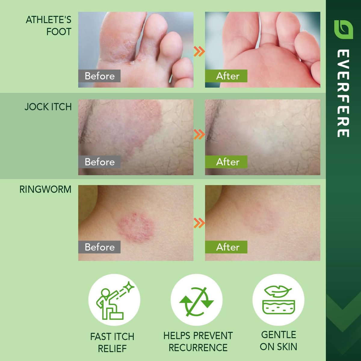 EVERFERE 22 % Undecylenate Complex Antifungal Creme: Behandelt Fußpilz, Jock Itch & Ringelflechte, Lindert Juckreiz, Brennen, Schuppen & Risse - Pilzcreme für empfindliche Haut, 60 g Glas