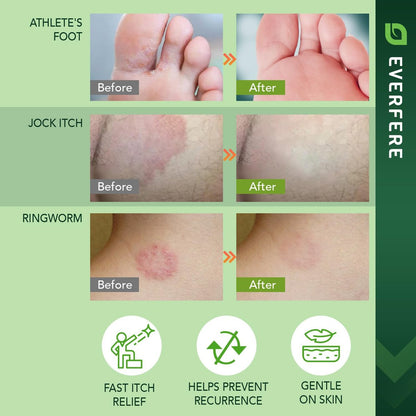 EVERFERE 22 % Undecylenate Complex Antifungal Creme: Behandelt Fußpilz, Jock Itch & Ringelflechte, Lindert Juckreiz, Brennen, Schuppen & Risse - Pilzcreme für empfindliche Haut, 60 g Glas