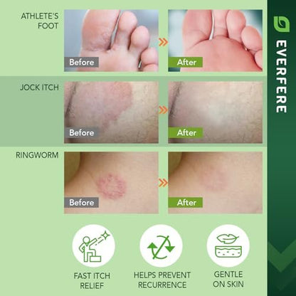 EVERFERE 22 % Undecylenate Complex Antifungal Creme: Behandelt Fußpilz, Jock Itch & Ringelflechte, Lindert Juckreiz, Brennen, Schuppen & Risse - Pilzcreme für empfindliche Haut, 60 g Glas