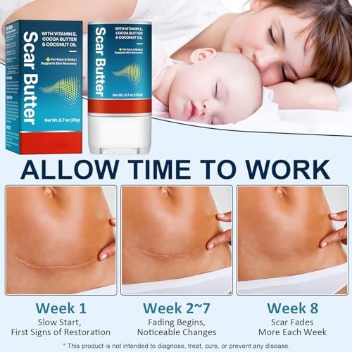 Scar Stick für Narben nach Operationen & Kaiserschnitt – Kakaobutter-Stick mit Vitamin E, 5-in-1 Glättungsformel zur Verbesserung von Textur & Verfärbungen, nicht fettend (0,7 oz)