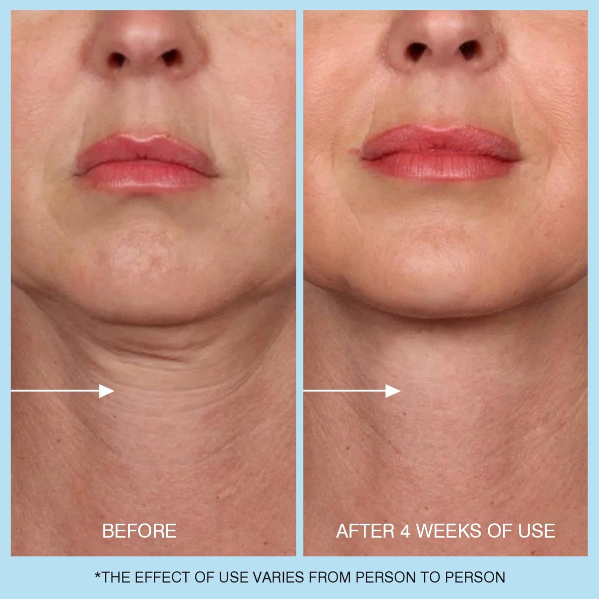 Retinol Halscreme - Hyaluronsäure & Koffein Angereicherte Halsstraffende Creme | Anti-Aging 3-in-1 Feuchtigkeitscreme zur Minimierung von feinen Linien, Fältchen und schlaffer Haut für Hals, Dekolleté und Gesicht (50ml/1.7oz)