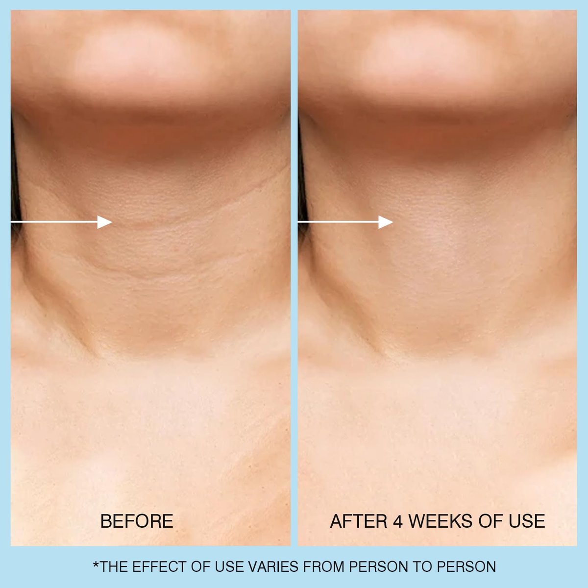 Retinol Halscreme - Hyaluronsäure & Koffein Angereicherte Halsstraffende Creme | Anti-Aging 3-in-1 Feuchtigkeitscreme zur Minimierung von feinen Linien, Fältchen und schlaffer Haut für Hals, Dekolleté und Gesicht (50ml/1.7oz)