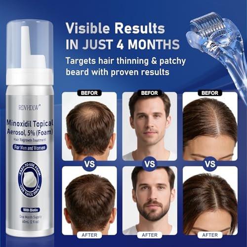 5% Minoxidil Schaum für Männer und Frauen Haarwuchs, Minoxidil Schaum für Haare und Bart, Haarwuchsbehandlung hilft bei Haarausfall und dünner werdendem Haar (7 Stück, 14,77 Unzen, 7 Monate Vorrat)