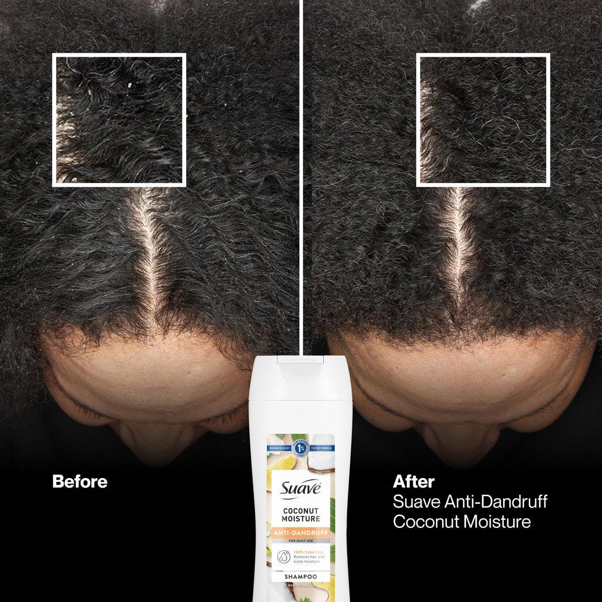 Suave Anti-Schuppen Shampoo für Frauen, Kokosnuss-Feuchtigkeit, 1% Pyrithion-Zink Schuppenbehandlung, kontrolliert Flocken, Juckreiz & trockene Kopfhaut, 6er-Pack, 12,6 FL OZ