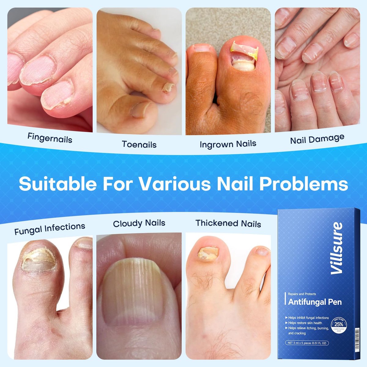 Villsure Nagelpilz Stift - Extra starke Nagelpilzbehandlung mit 25% Undecensäure, Teebaumölen und natürlichen Inhaltsstoffen, mild und nicht reizend - 5 Stifte