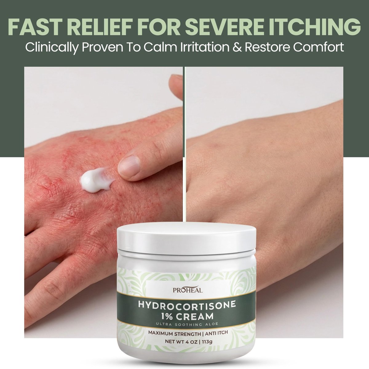 ProHeal 1% Hydrocortison Creme Maximum Stärke mit Aloe Vera - 113g Anti-Juckreiz Creme bei Insektenstichen, Ekzemen, Giftefeu, Gifteiche, Giftsumach und mehr