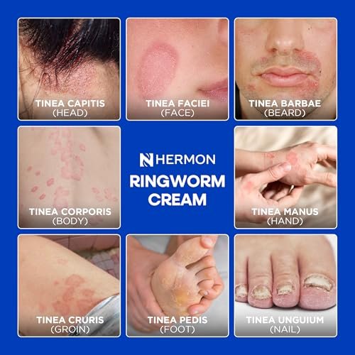 Hermon Antimykotische Reinigungsseife für Ringelflechte – Tägliches Duschgel gegen Fußpilz & Jock Itch – Teebaumöl & Schwefel Formel – Sanfte Hautbarrierepflege – 2er Pack