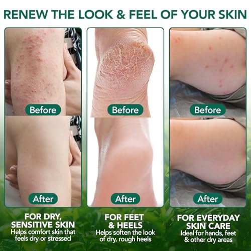 Tea Tree Oil Balsam – Natürliche Pflege für Haut, Füße & mehr | bnHUlMXw