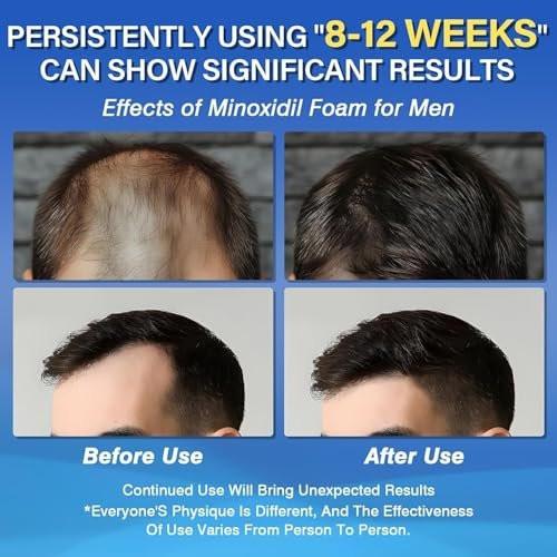 Minoxidil 5% Schaum für Männer – Haarwachstum, gegen Haarausfall und lichte Stellen