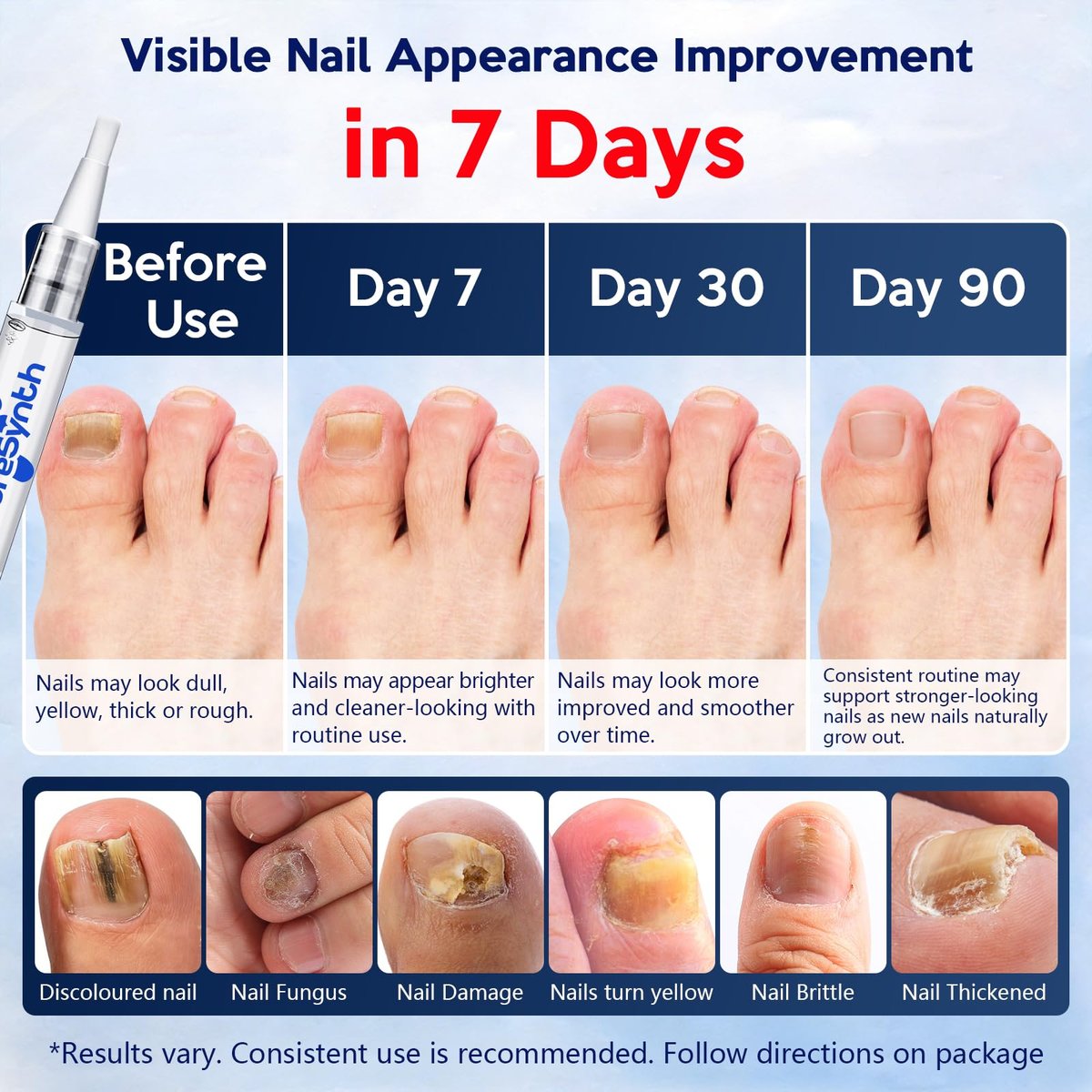 Extra Starkes Nagelpilz-Reparatur-Pen (OTC Maximalstärke), 25% Undecylensäure + Aloe & Vitamin E, für dicke gelb verfärbte Nägel, 12 ml (0,41 fl oz) Gesamt, 4er-Pack, Designed in USA
