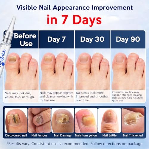 Extra Starkes Nagelpilz-Reparatur-Pen (OTC Maximalstärke), 25% Undecylensäure + Aloe & Vitamin E, für dicke gelb verfärbte Nägel, 12 ml (0,41 fl oz) Gesamt, 4er-Pack, Designed in USA